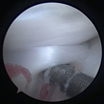 Medial Meniscus Damage