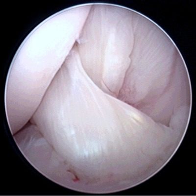 Normal Cranial Cruciate Ligament