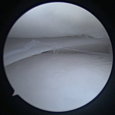 Normal Meniscus