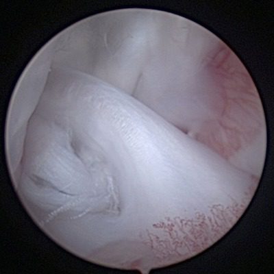 Partial Cranial Cruciate Ligament Tear